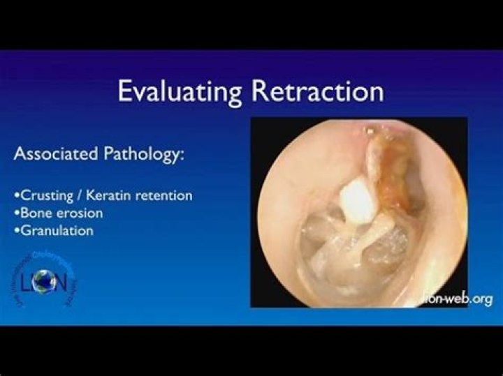 Retracted