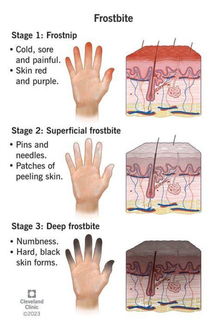 What does Frostbite do?